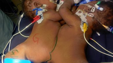 Photo of Successfully Separated Formerly Conjoined Twins Still At Mulago